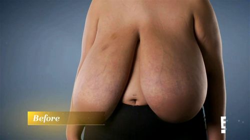 Watch Carlena reduction (warning gore surgery) - Macromastia, Ugly, Big Boobs Porn photo